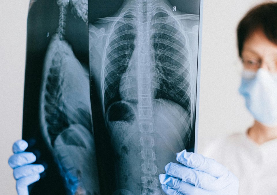 What Is Black Lung Disease?